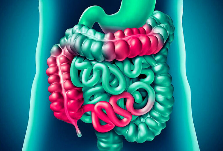 Enfermedad de Crohn: Lo Que Necesitas Saber