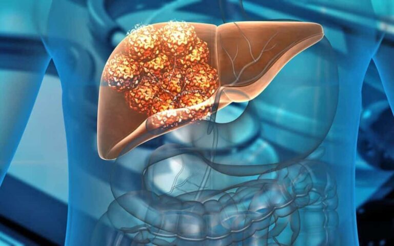 Conoce sobre la Cirrosis Hepática