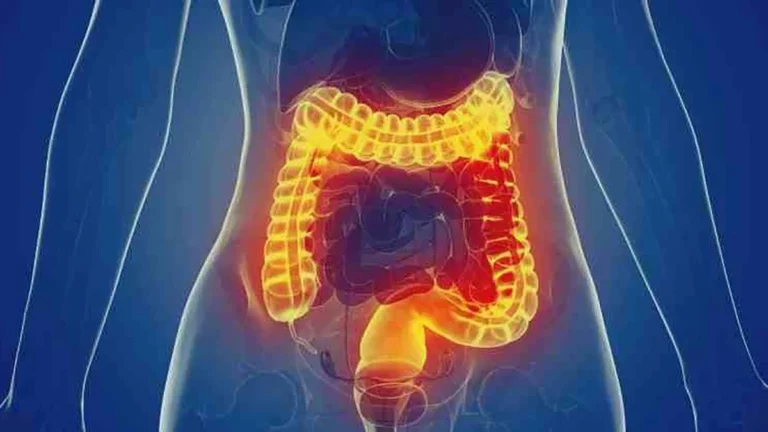 Diverticulitis Intestinal: Conoce Todo sobre Esta Enfermedad